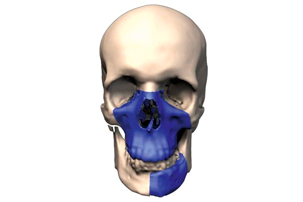 3D Printing a New Face