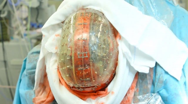 First 3D-printed Skull implanted